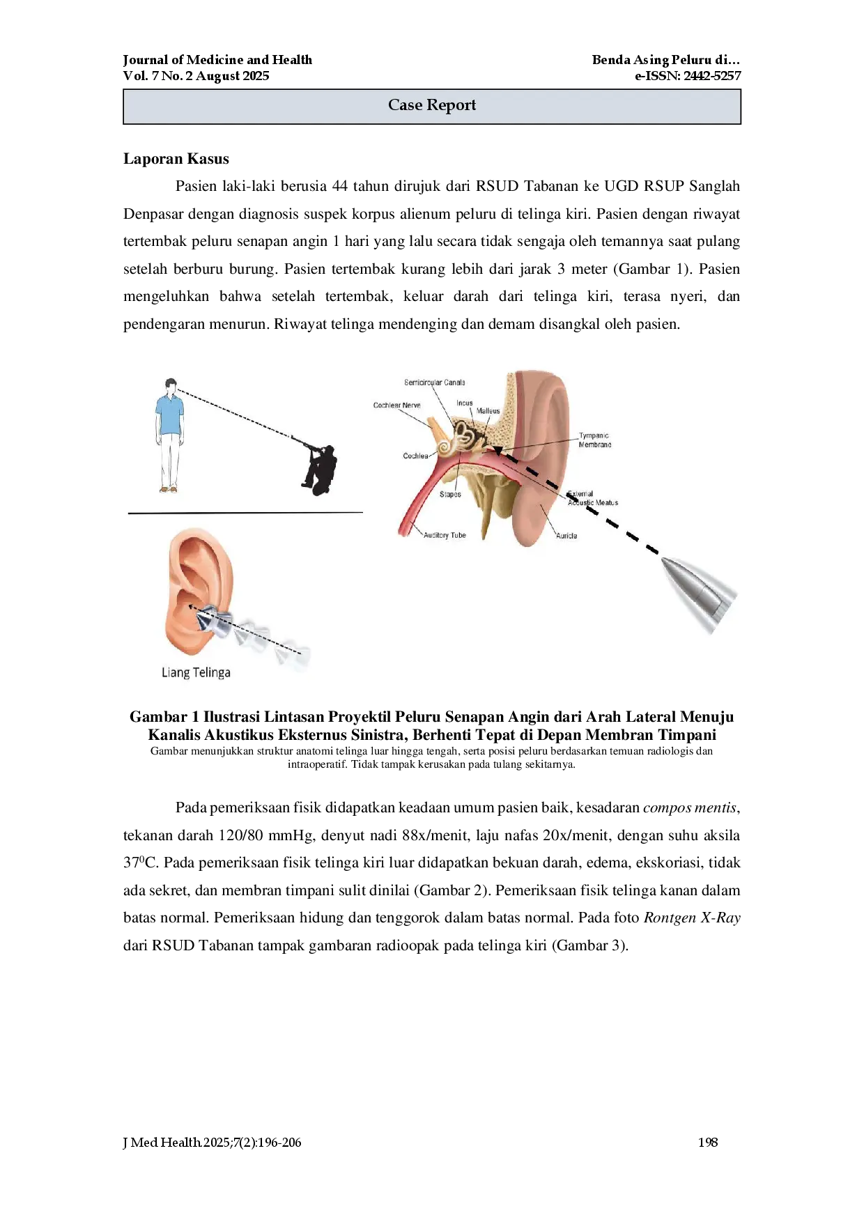 juris Benda Asing Peluru di Kanalis Akustikus Eskternus