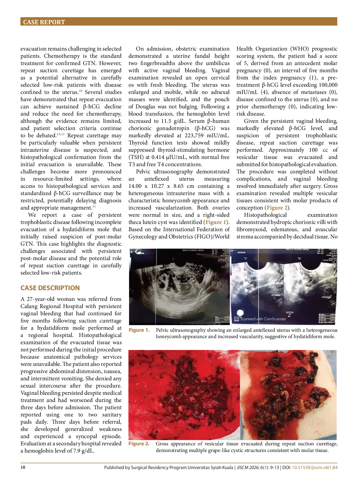 JURIS Persistent hydatidiform mole following incomplete evacuation mimicking post molar gestational trophoblastic neoplasia successfully managed with repeat suction curettage a case report