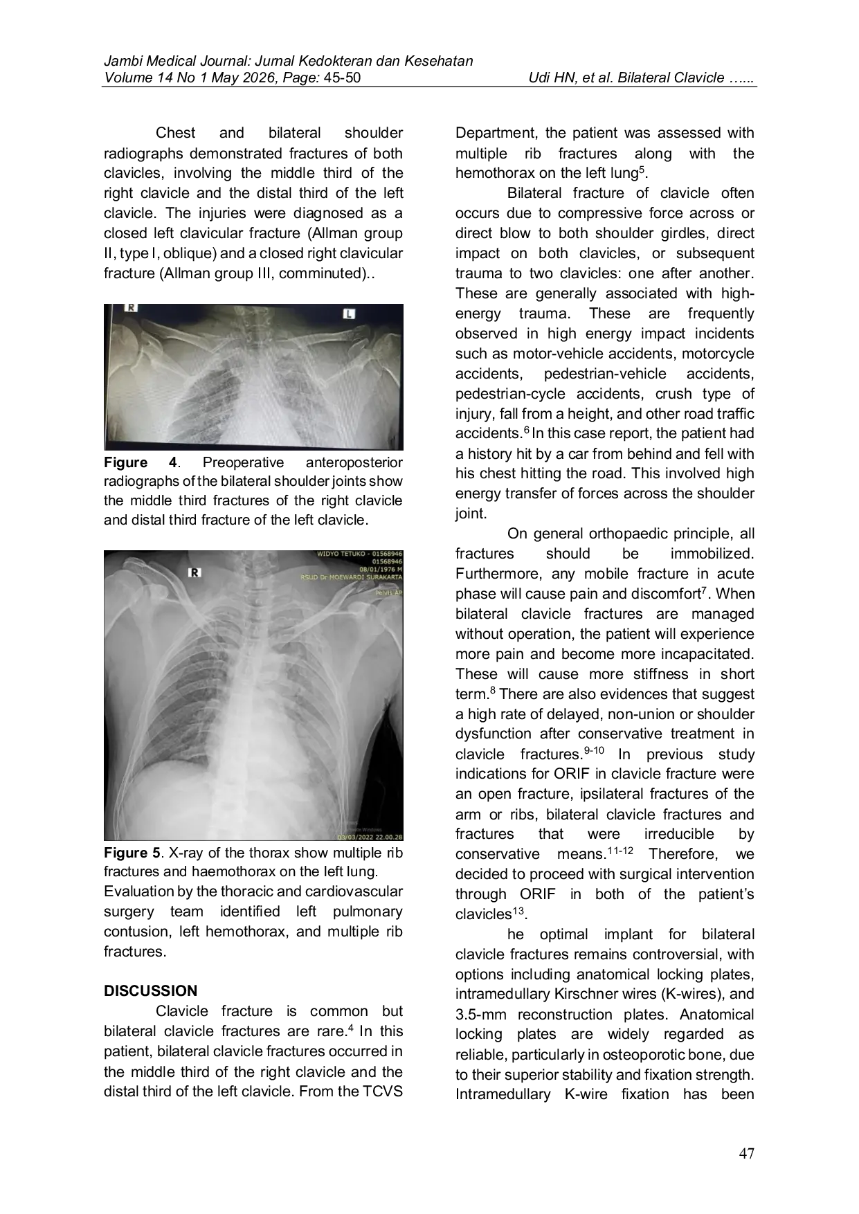JURIS Bilateral Clavicle Fractures with Multiple Rib Fractures and Hemothorax A Case Report