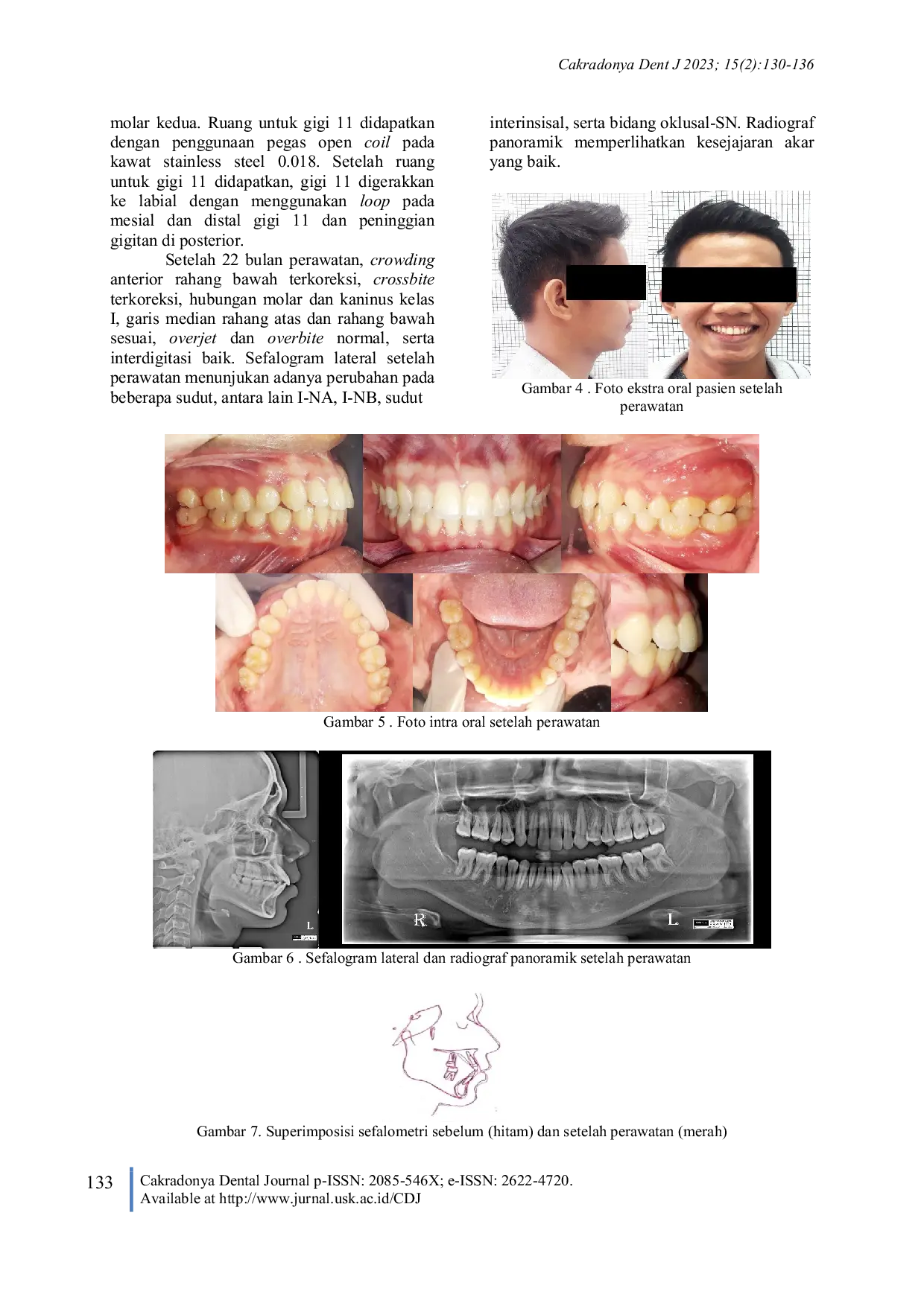JURIS Perawatan Maloklusi Dentoskeletal Kelas I Disertai Crossbite Anterior Dengan Teknik Standar Edgewise Laporan Kasus