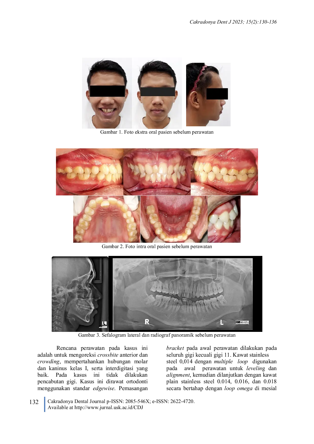 JURIS Perawatan Maloklusi Dentoskeletal Kelas I Disertai Crossbite Anterior Dengan Teknik Standar Edgewise Laporan Kasus