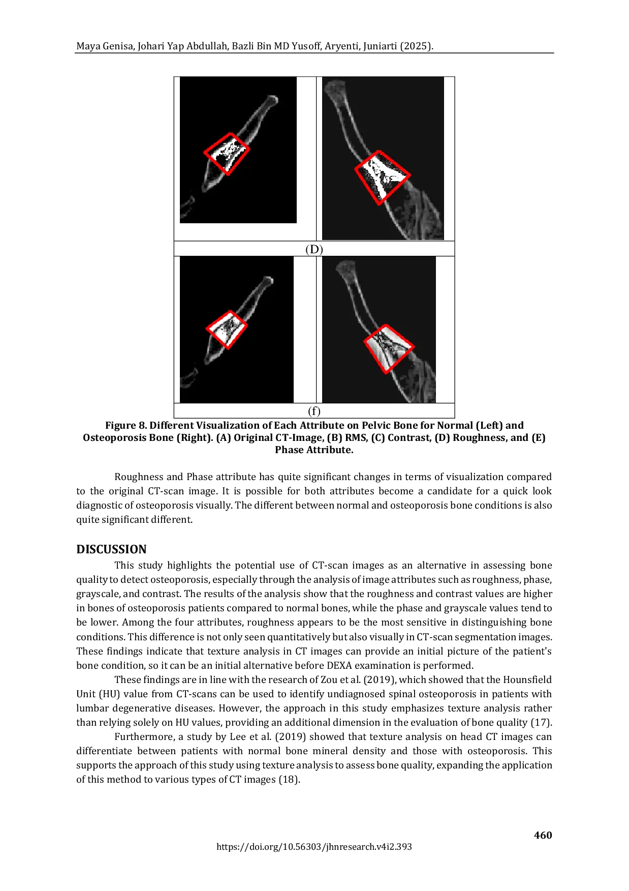 JURIS How Osteoporosis Looks Like in CT Scan Images An Alternative Osteoporosis Assessment