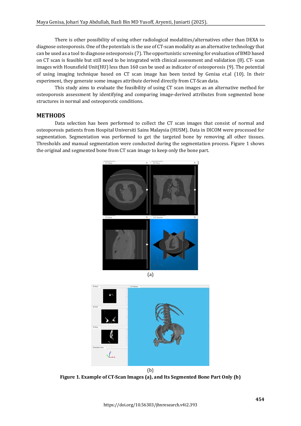 JURIS How Osteoporosis Looks Like in CT Scan Images An Alternative Osteoporosis Assessment