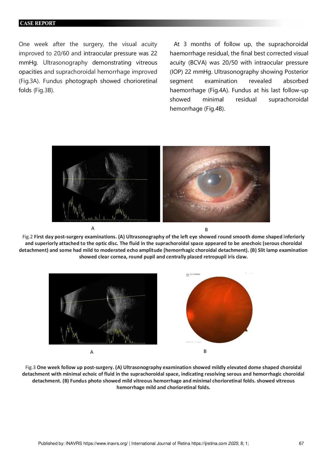 JURIS Suprachoroidal Haemorrhage Caused By Valsalva Maneuver During Vitrectomy A Case Report