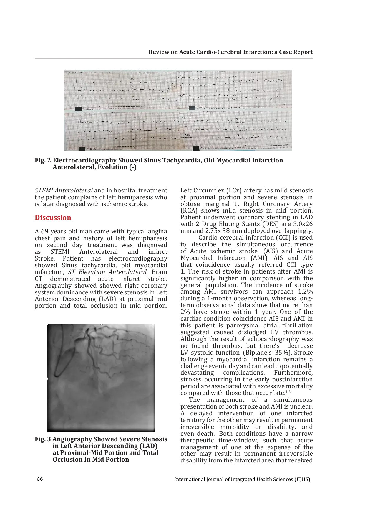 JURIS Review on Acute Cardio Cerebral Infarction a Case Report