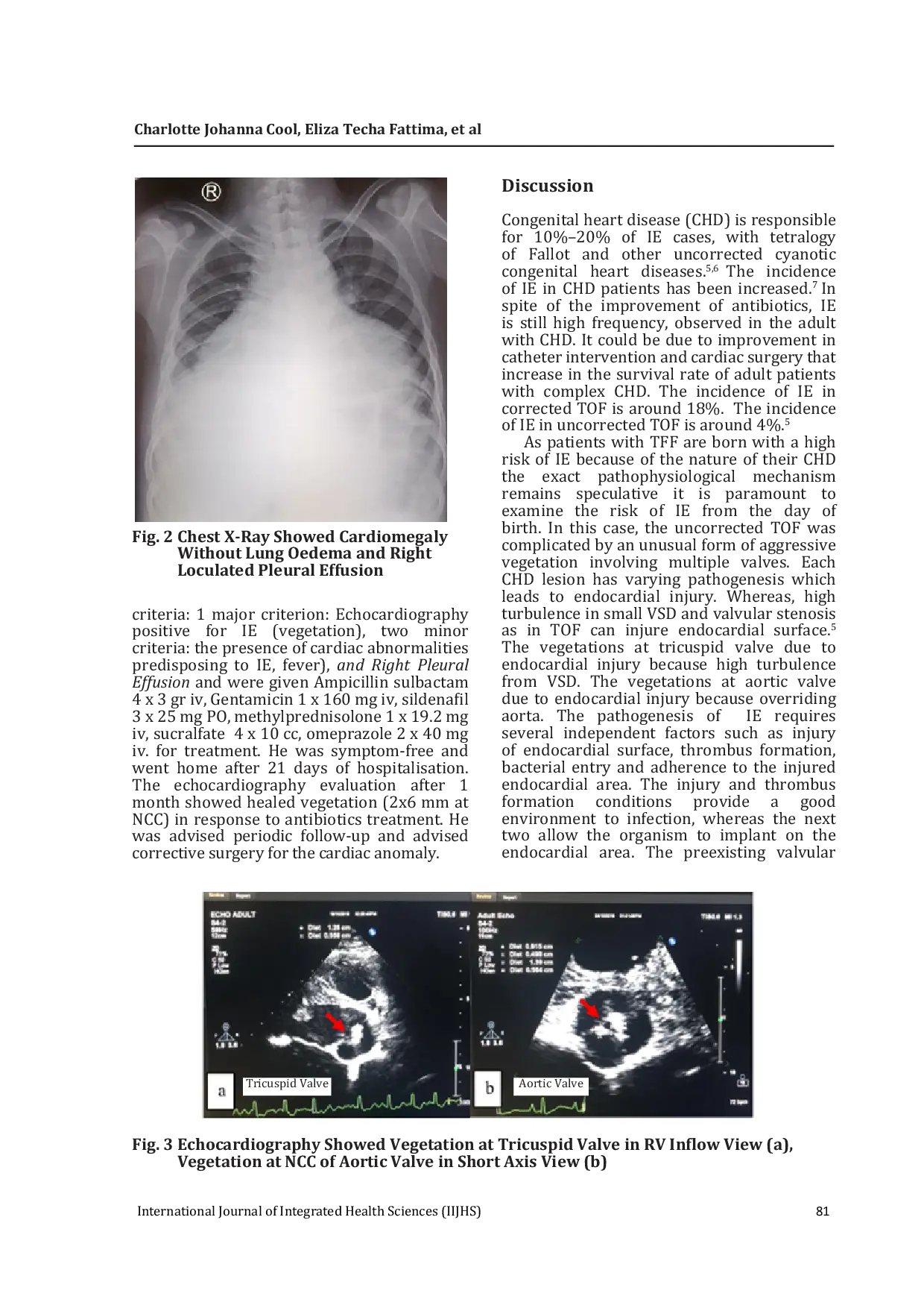 JURIS Infective Endocarditis with Multiple Valvar Vegetation in Uncorrected Tetralogy Fallot A Case Report of Rare Condition