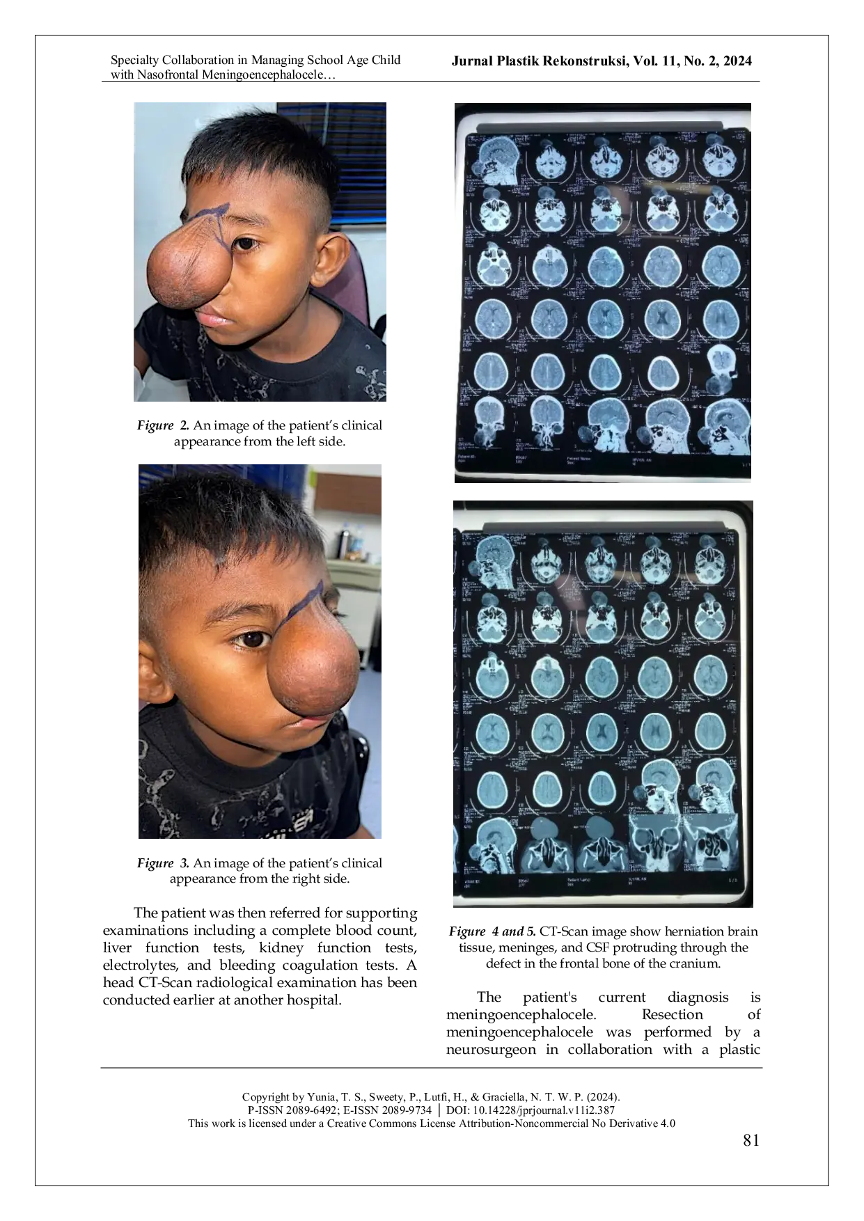 JURIS Specialty Collaboration in Managing School Age Child with Nasofrontal Meningoencephalocele A Case Report