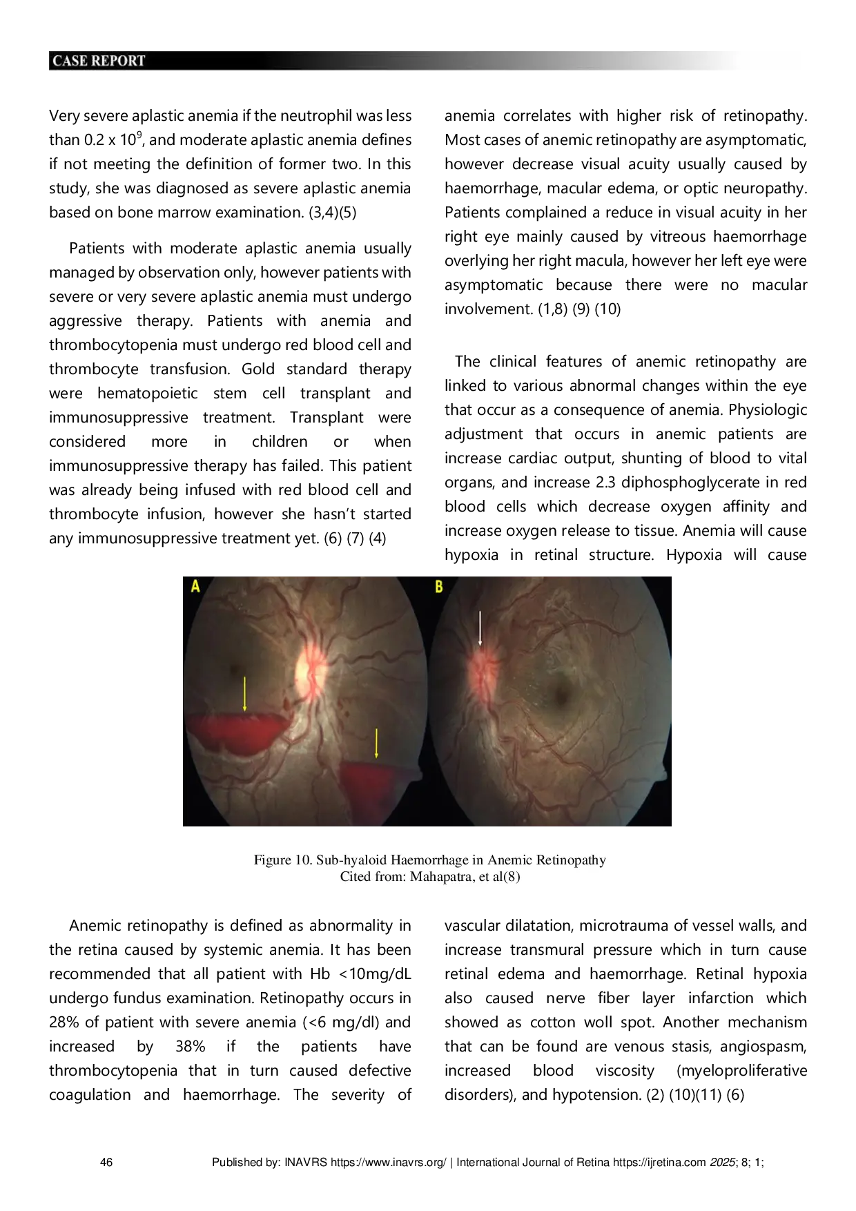 JURIS Ocular Manifestations of Aplastic Anemia Rare Case of Anemic Retinopathy
