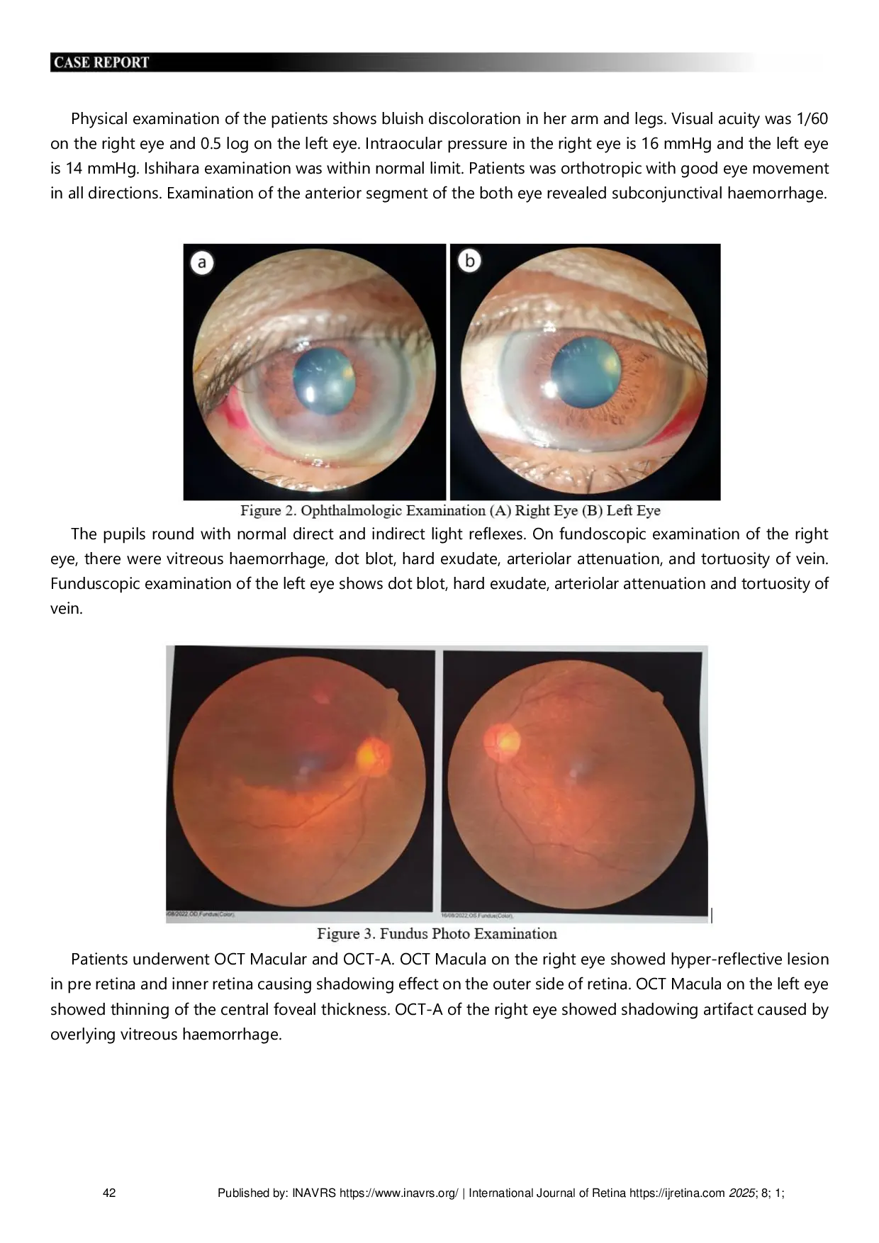 JURIS Ocular Manifestations of Aplastic Anemia Rare Case of Anemic Retinopathy