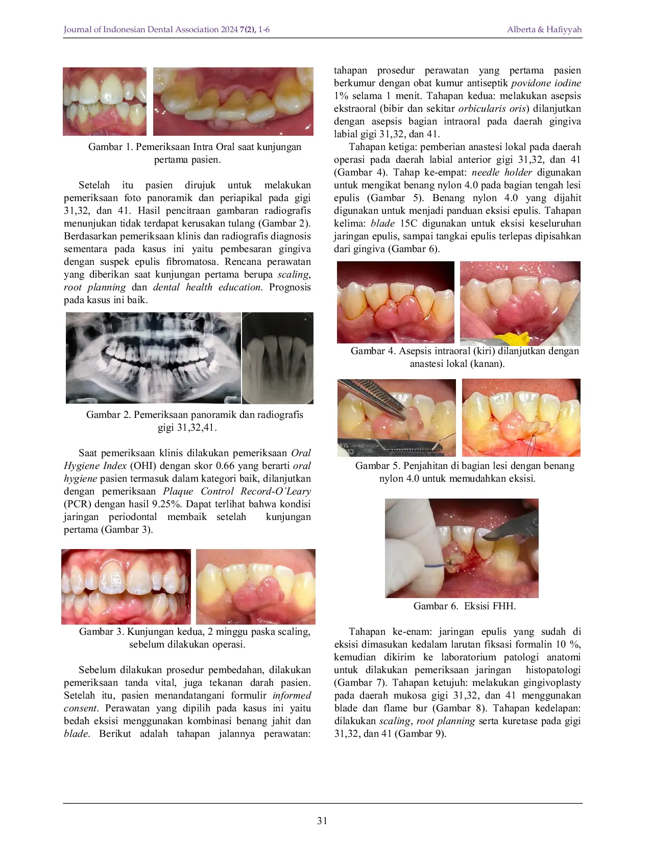 JURIS Removal of Focal Fibrous Hyperplasia on Aesthetic Area of Lower Teeth