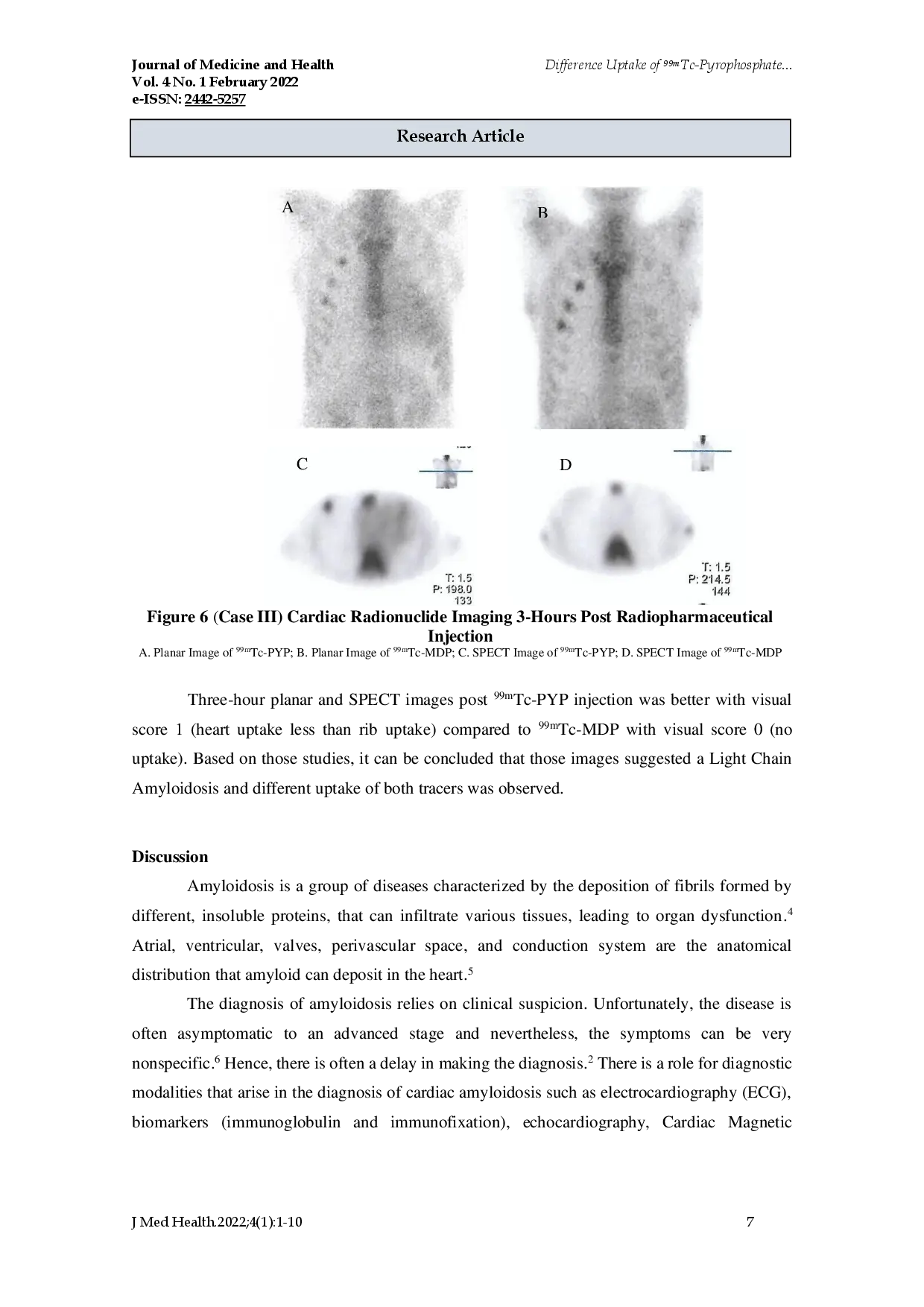juris Difference Uptake of 99mTc Pyrophosphate vs 99mTc Methylenediphosphate in Detecting Cardiac Amyloidosis First Experience in Hasan Sadikin General Hospital