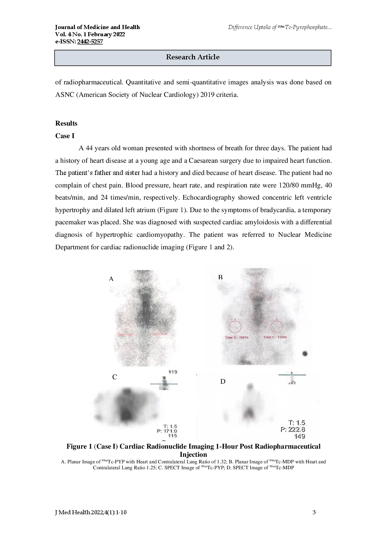 juris Difference Uptake of 99mTc Pyrophosphate vs 99mTc Methylenediphosphate in Detecting Cardiac Amyloidosis First Experience in Hasan Sadikin General Hospital