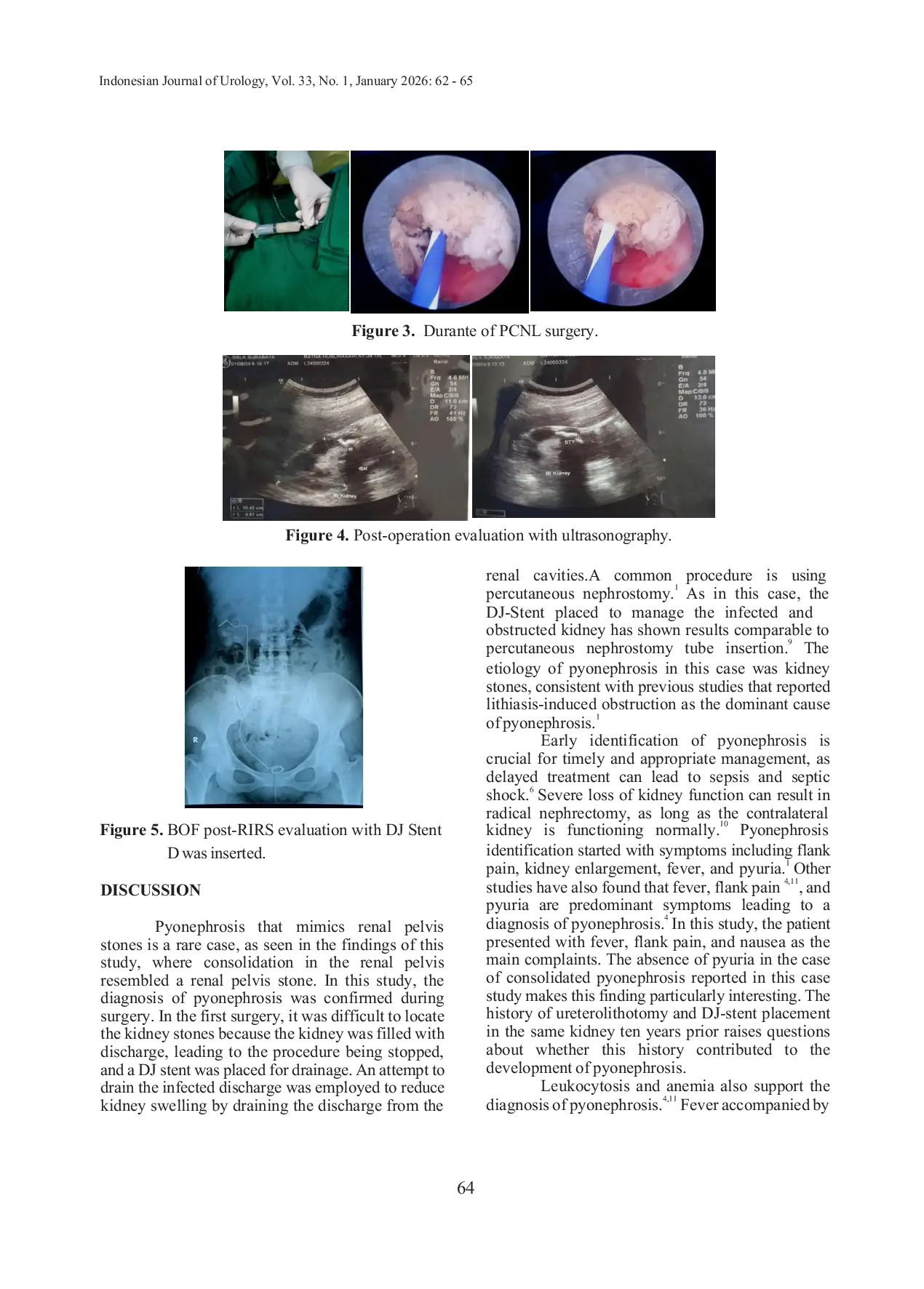 JURIS MANAGEMENT OF CONSOLIDATED PYONEPHROSIS MIMICKING PYELUM STONE IN A PATIENT WITH URETEROLITHOTOMY HISTORY A CASE REPORT