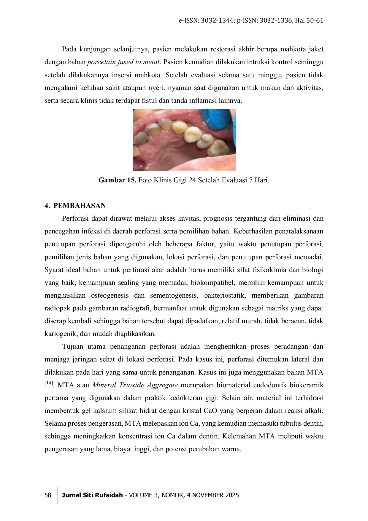 JURIS Laporan Kasus Penatalaksanaan Pulpitis Irreverisble Asimptomatik Gigi 24 Disertai Perforasi Lateral Berbahan MTA Mineral Trioxide Aggregate