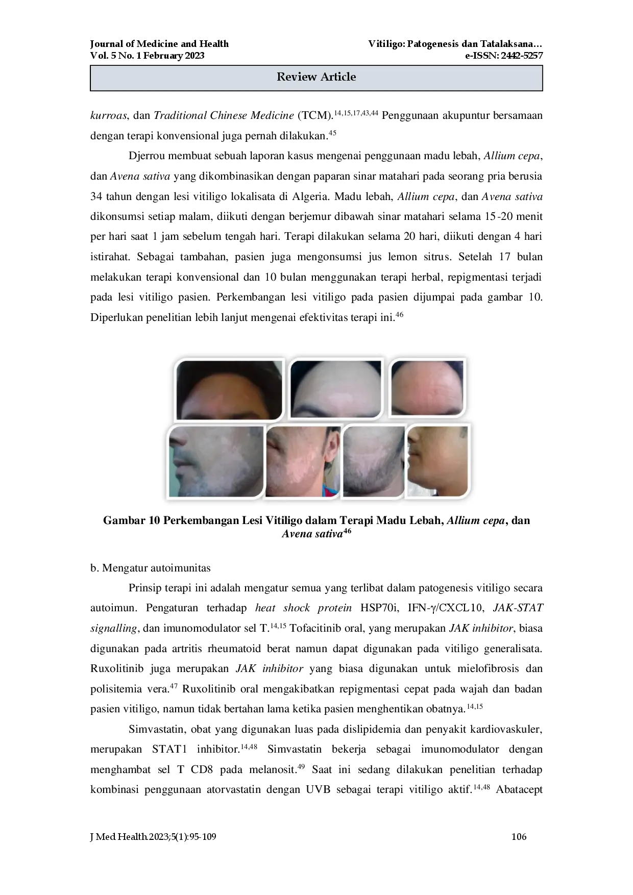 juris Vitiligo Patogenesis Diagnosis dan Tatalaksana Terbaru