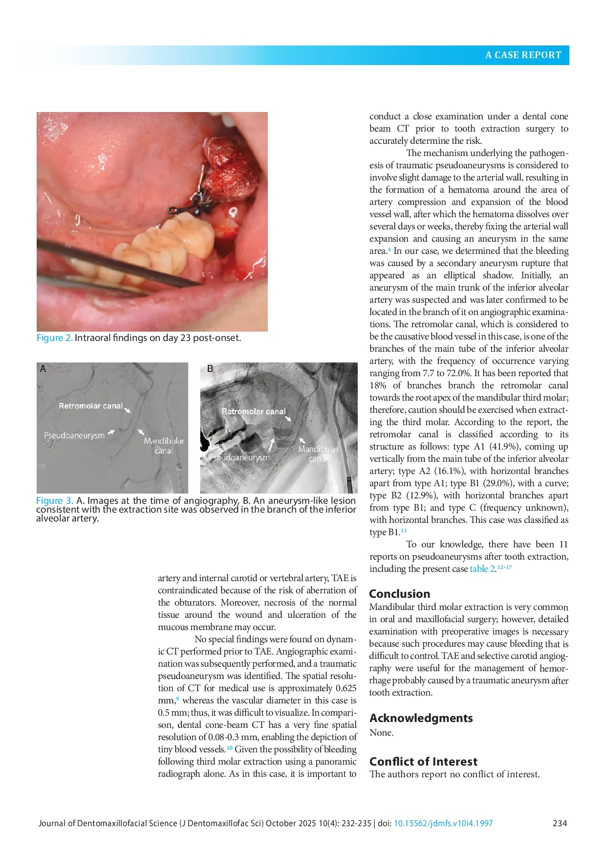JURIS Pseudoaneurysm developing after extraction of the mandibular third molar requiring transcatheter arterial embolization A case report and literature review