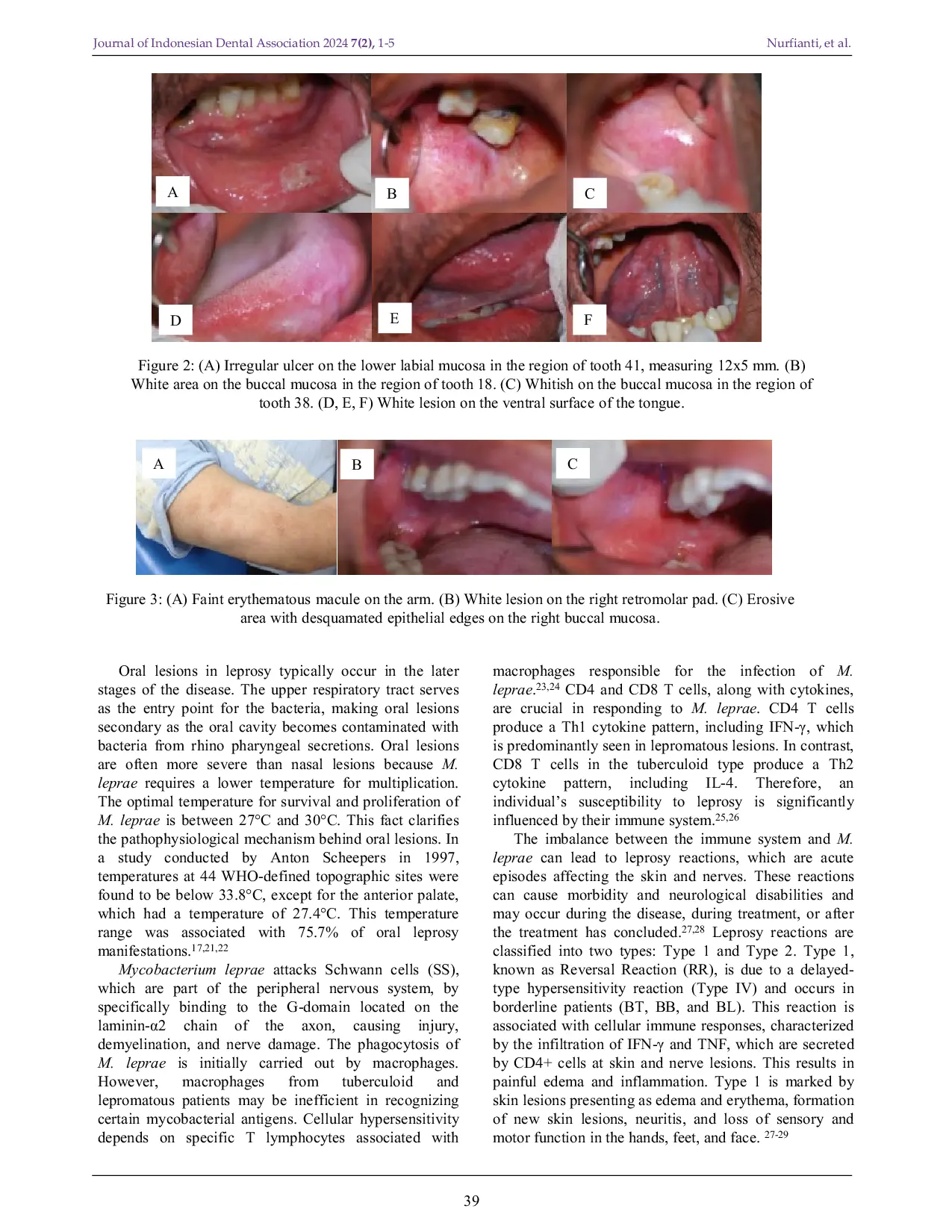 JURIS The Forgotten Infection Cases Leprosy Disease Oral Manifestations and Its Problem