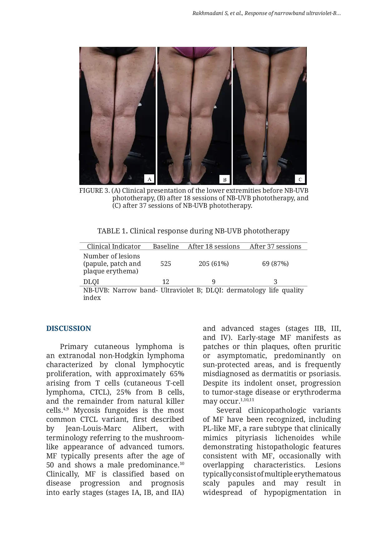 JURIS Response of narrowband ultraviolet B phototherapy in pityriasis lichenoides like mycosis fungoides a case report
