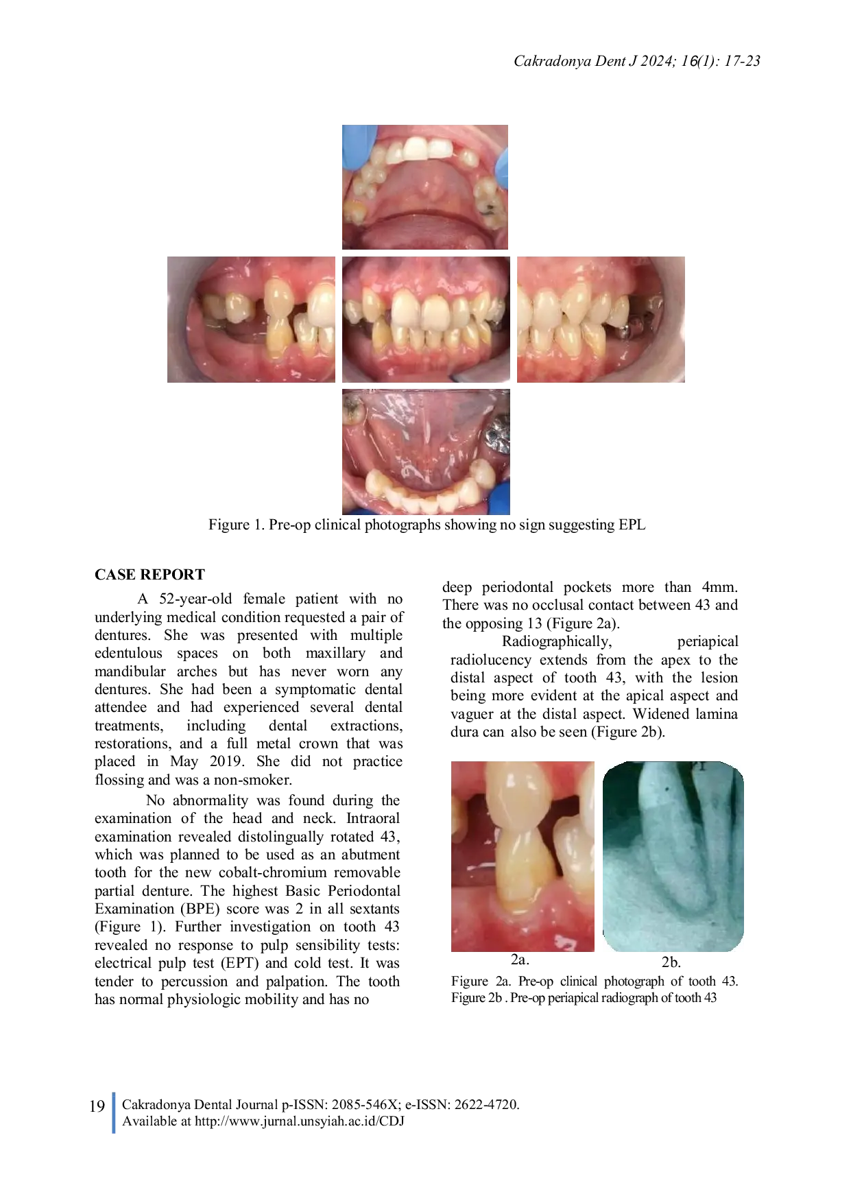 JURIS Implementing the 2017 EFP AAP Periodontal Disease Classification in The Diagnosis and Management of Endo Periodontal Lesions A Case Report