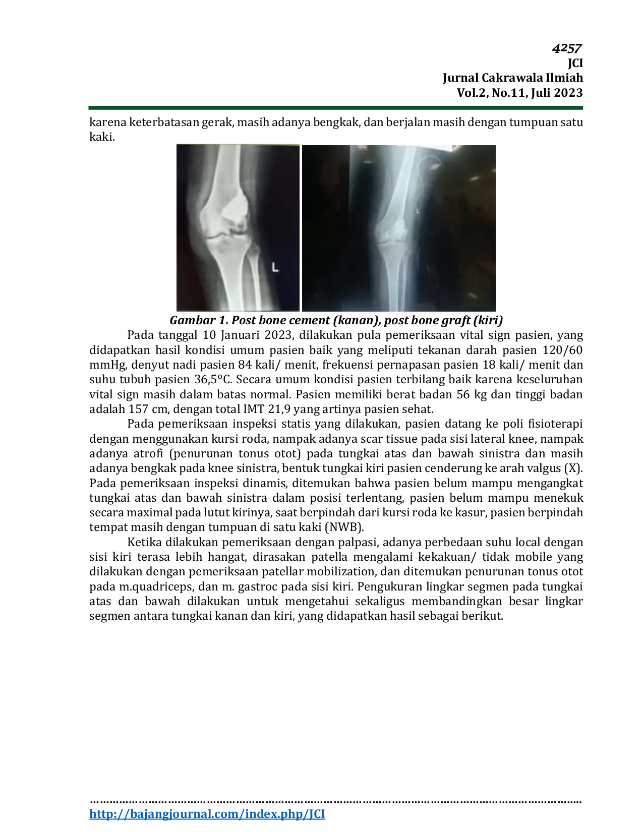 JURIS Penatalaksanaan Fisioterapi pada Gangguan Gerak dan Fungsi Ekstremitas Bawah pada Post Op Bone Graft pada Distal Femur Sinistra e c Aneurysmal Bone Cyst Case Report