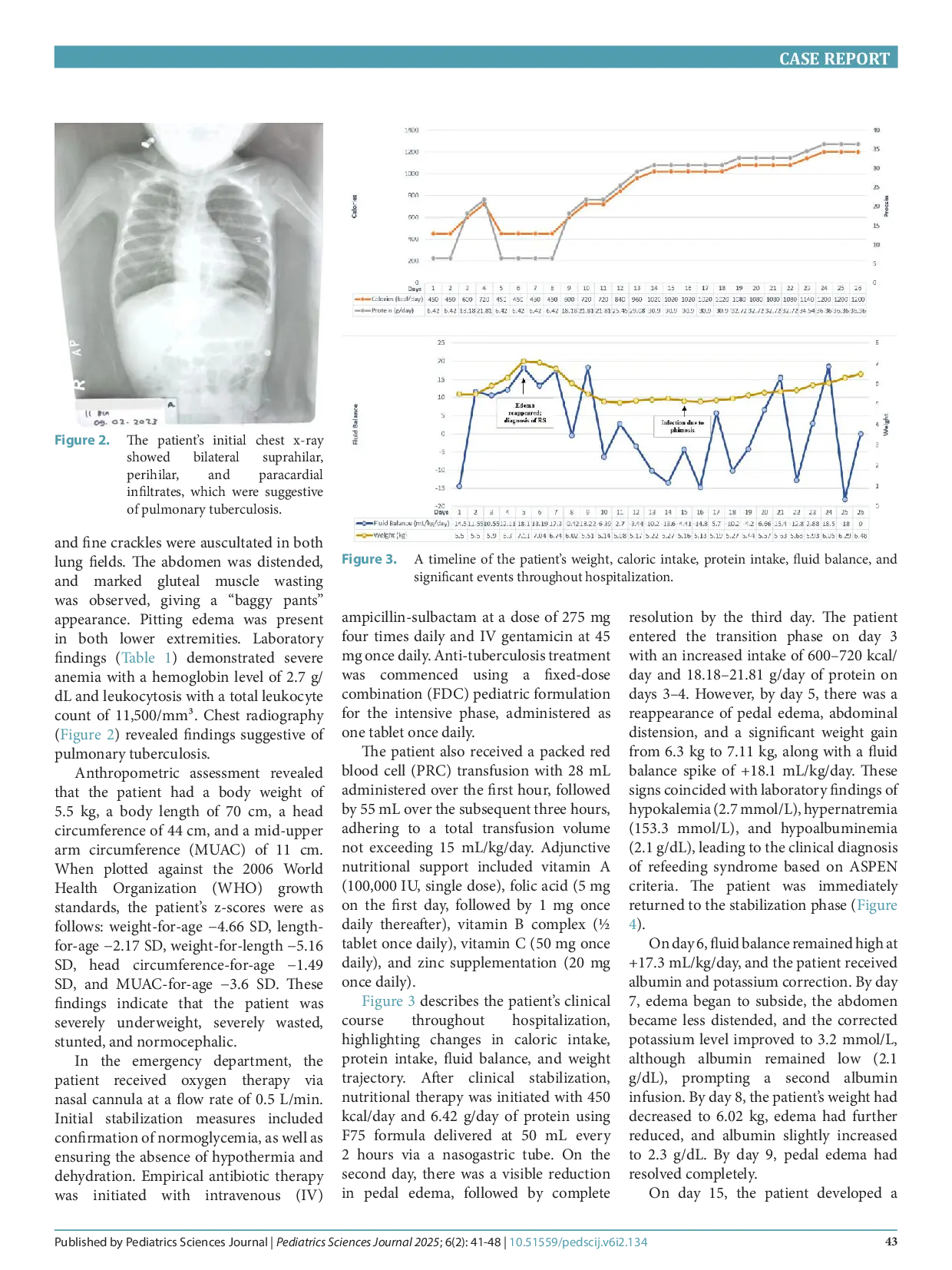 JURIS Management of refeeding syndrome in a severely wasted complex case pediatric patient in a limited facilities hospital a case report