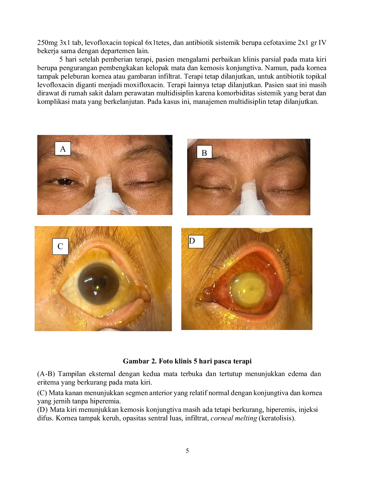 JURIS Selulitis Orbital Yang Menunjukkan Ciri Ciri Yang Menyerupai Glaukoma Akut Pada Pasien Dengan Gangguan Imunitas Tantangan Diagnostik