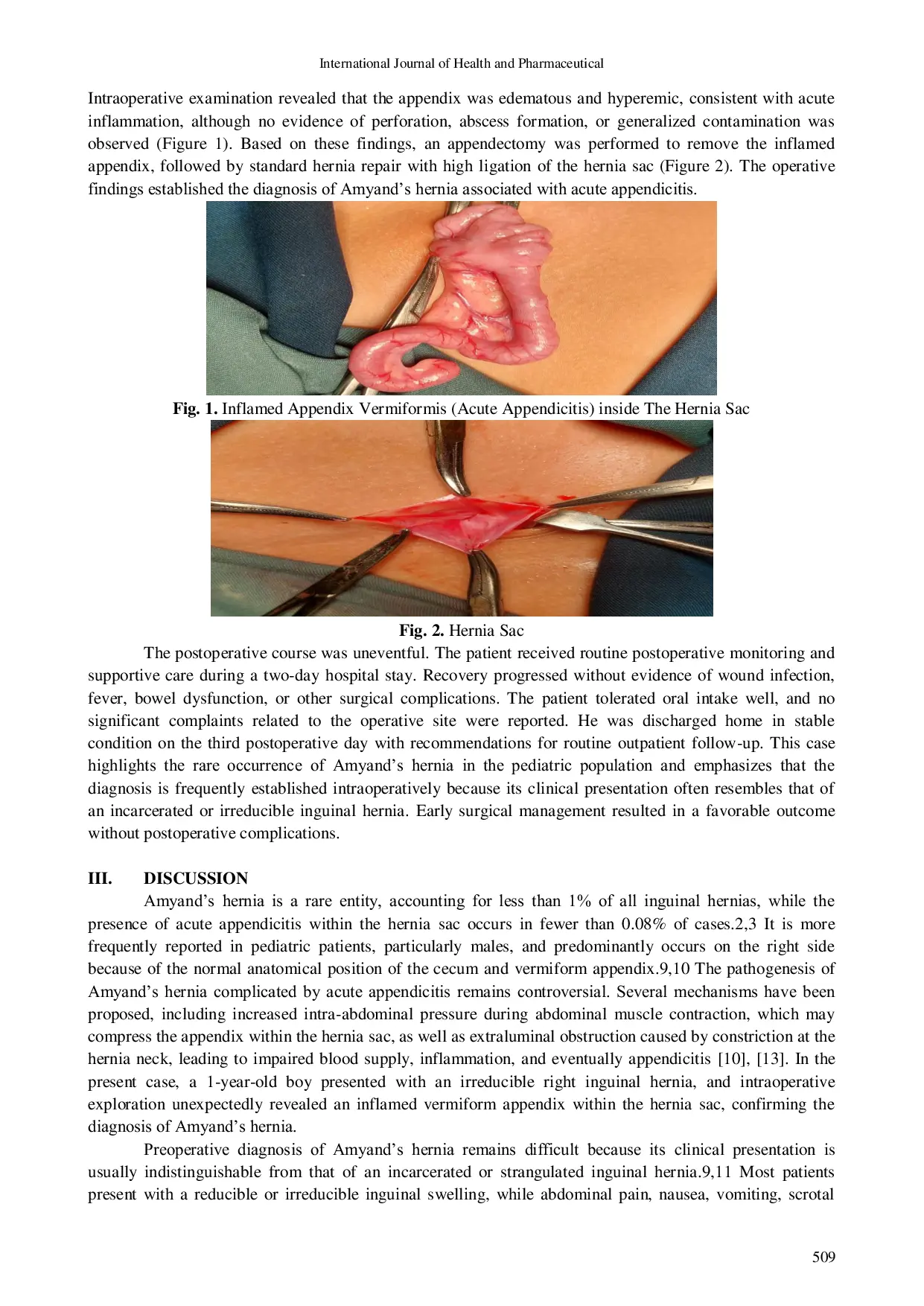 JURIS Amyand s Hernia in Children Intraoperative Finding A Rare Case Report From dr Azhar Zahir Naval Hospital Manokwari West Papua