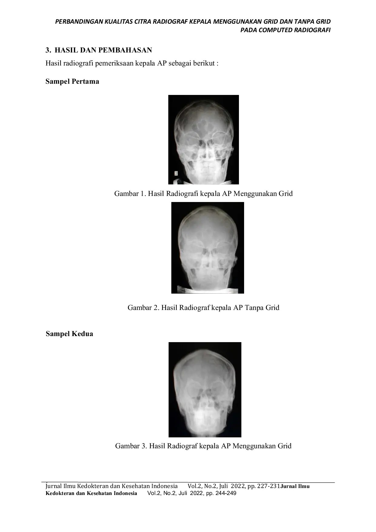 JURIS Perbandingan Kualitas Citra Radiograf Kepala Menggunakan Grid dan Tanpa Grid pada Computed Radiografi