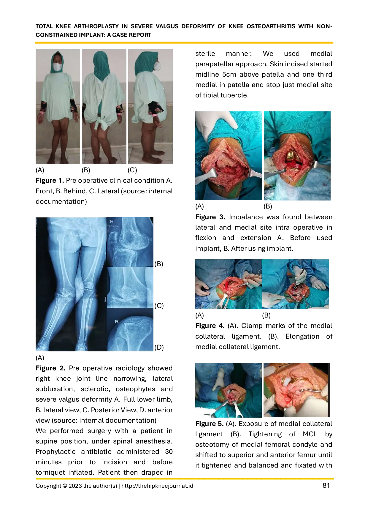 JURIS Total knee arthroplasty in severe valgus deformity of knee osteoarthritis with non constrained implant A Case Report