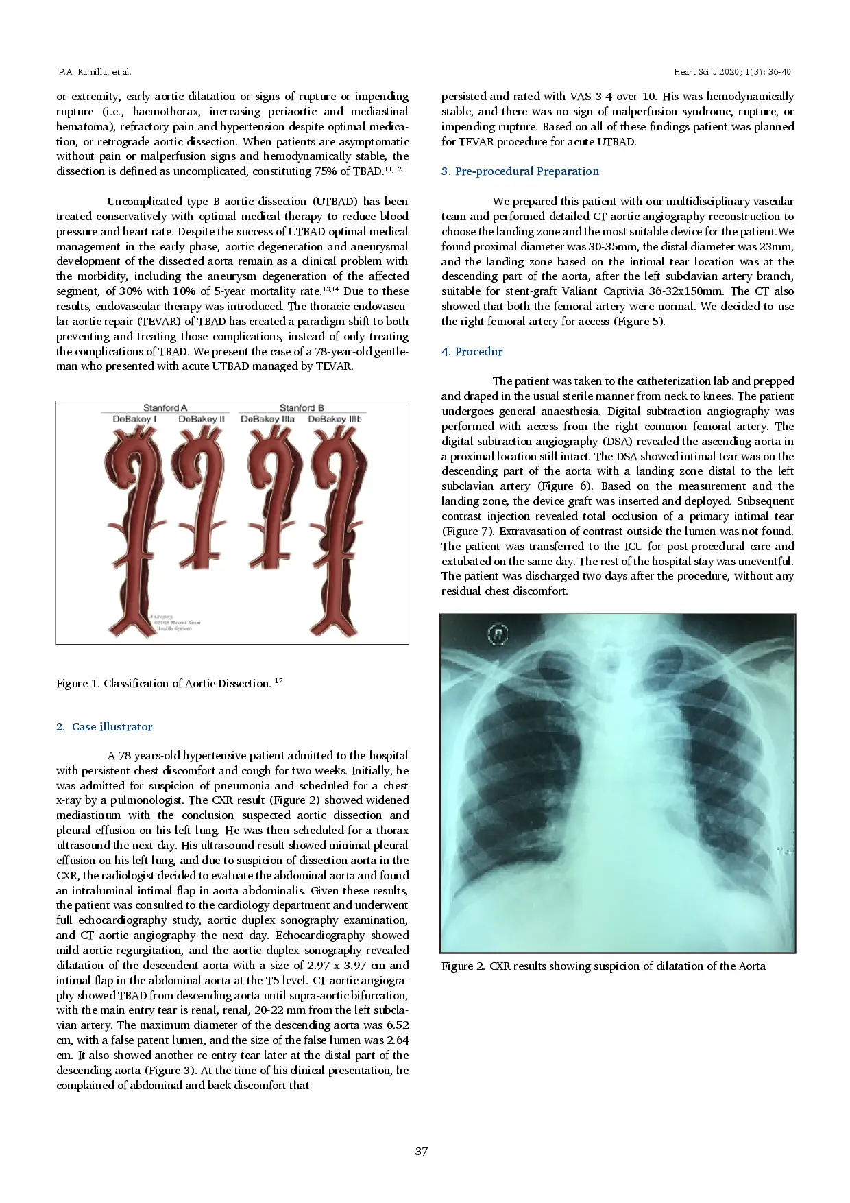 juris Management of Acute Uncomplicated Stanford B Aortic Dissection in The Era of Endovascular Repair A Case Report