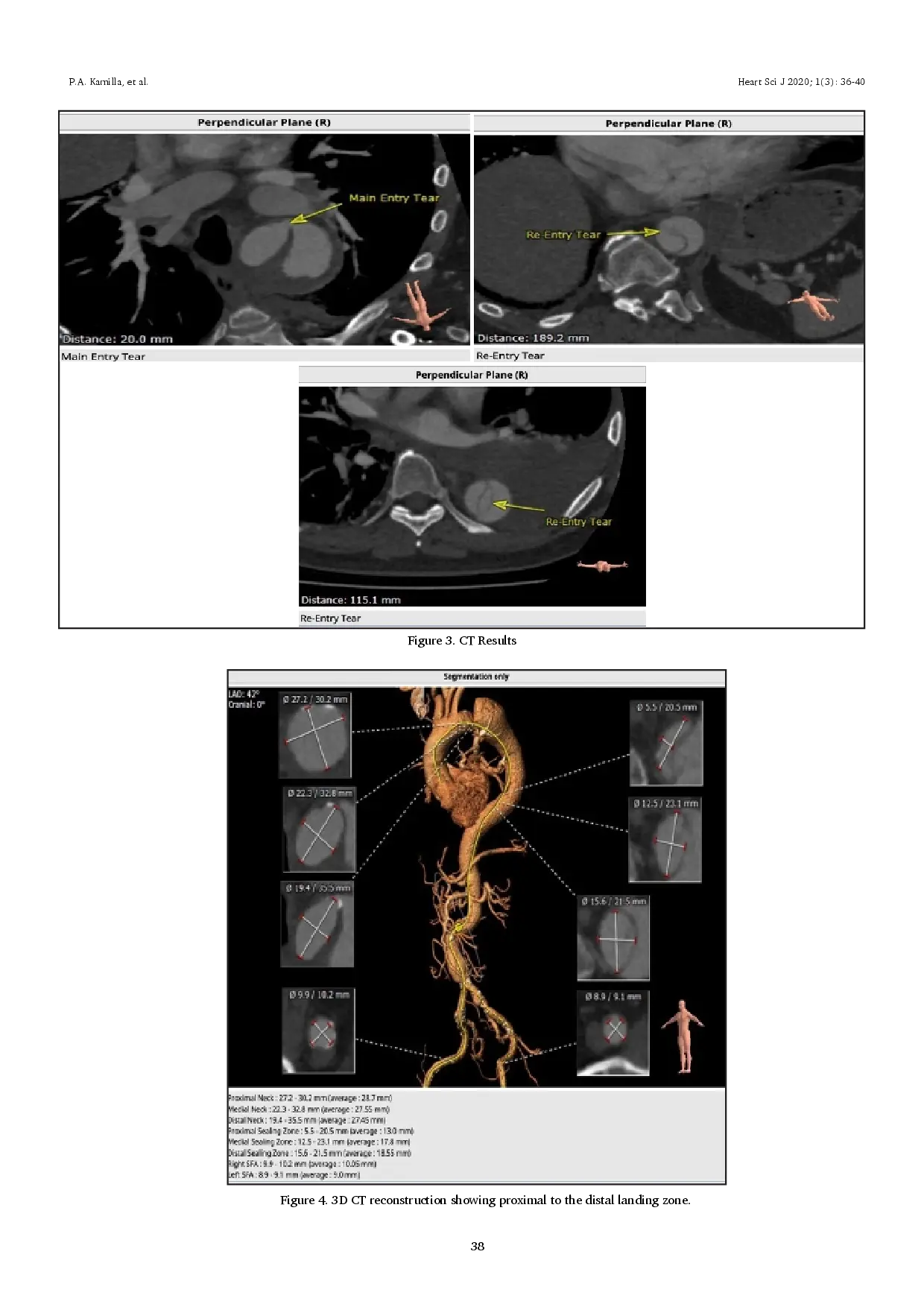 juris Management of Acute Uncomplicated Stanford B Aortic Dissection in The Era of Endovascular Repair A Case Report