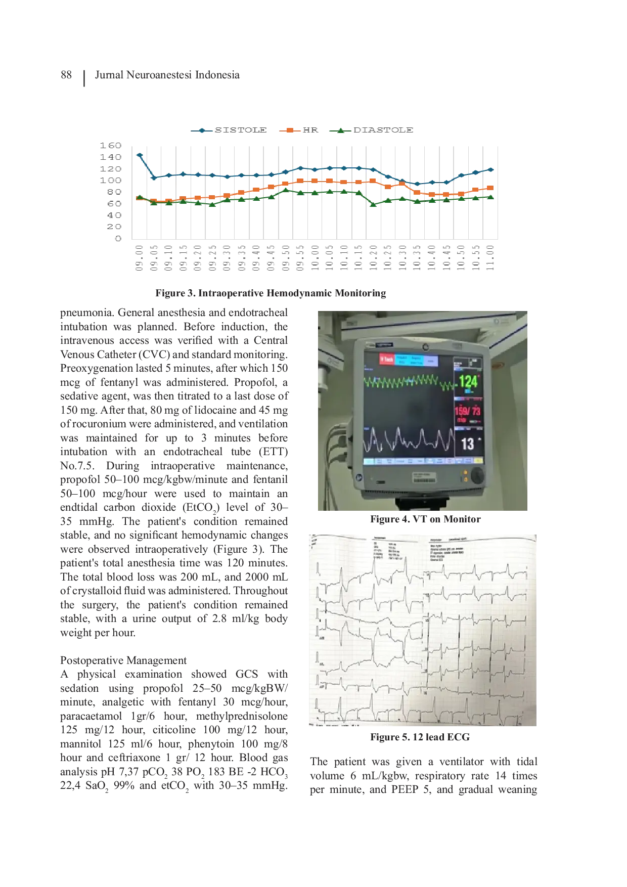 JURIS Adverse Event Myocardial Injury after Non Cardiac Surgery MINS Post Craniectomy in Critical Care