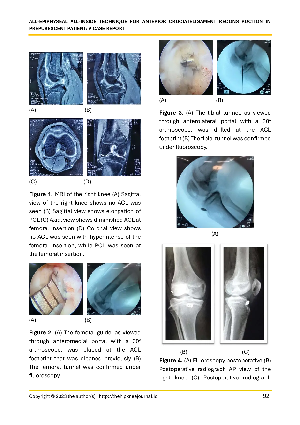 JURIS All epiphyseal All Inside Technique for Anterior Cruciate Ligament Reconstruction in Prepubescent Patient A Case Report
