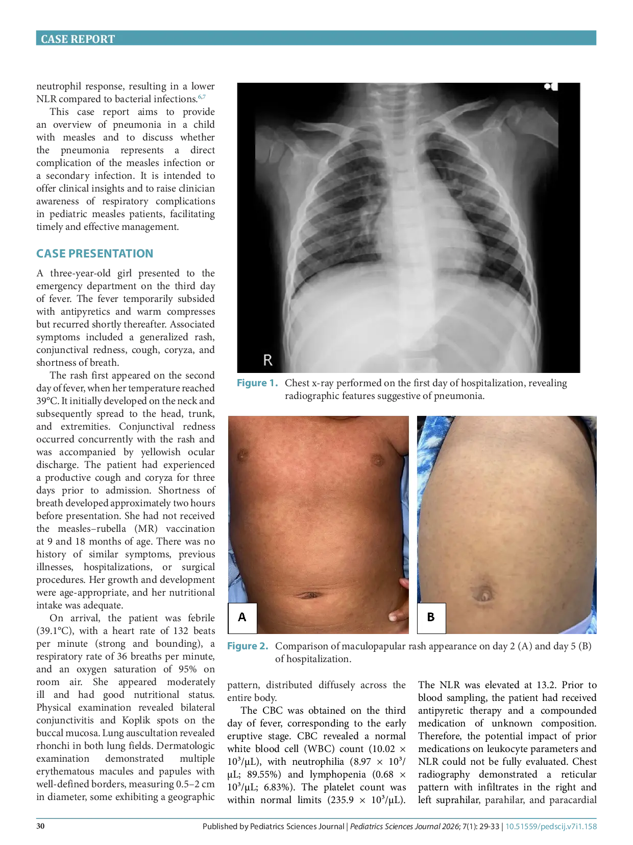 JURIS Pneumonia as a viral complication or secondary bacterial infection in a pediatric measles A case report