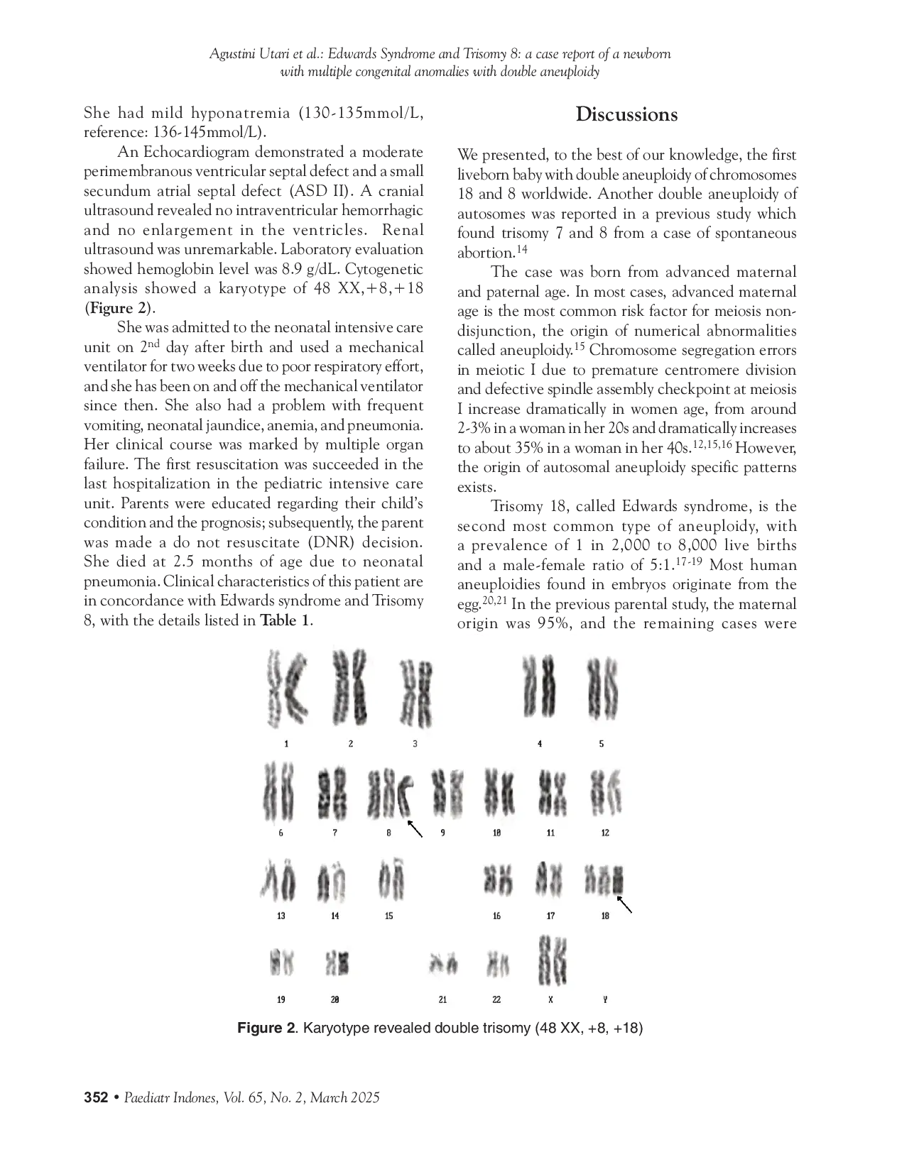 JURIS Edwards Syndrome and Trisomy 8 a case report of a newborn with multiple congenital anomalies with double aneuploidy