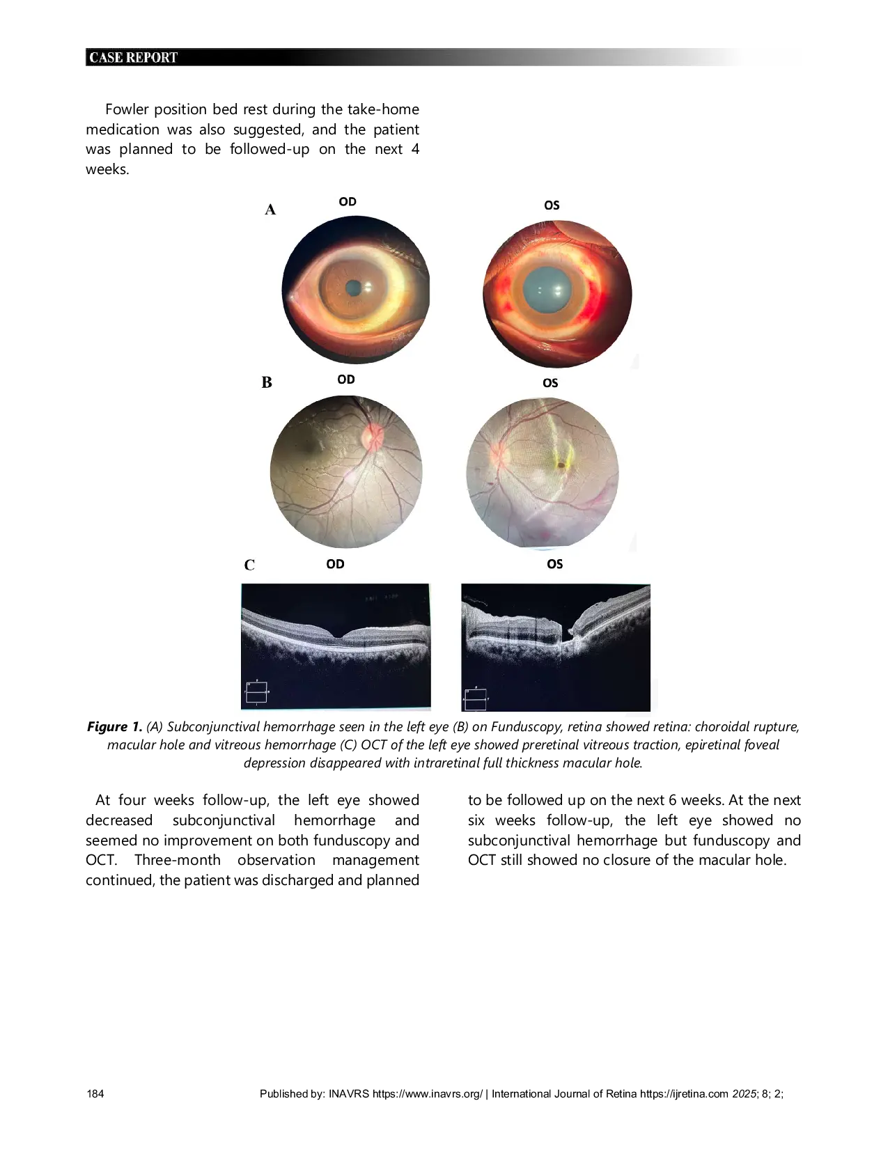 JURIS OBSERVATION VS SURGERY IN TRAUMATIC MACULAR HOLE A CASE REPORT HIGHLIGHTING FUNCTIONAL OUTCOME