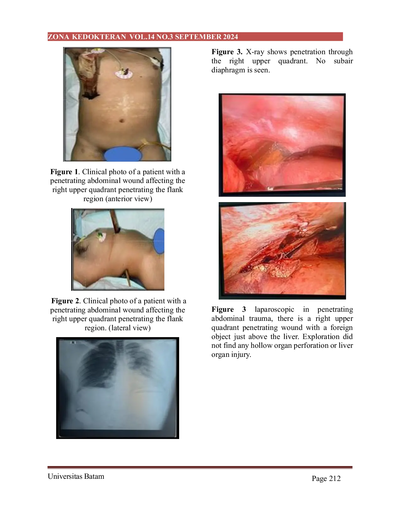 JURIS Successful Management of Sharp Abdominal Trauma With Diagnostic Laparoscopy at Dr Zainoel Abidin Aceh Hospital