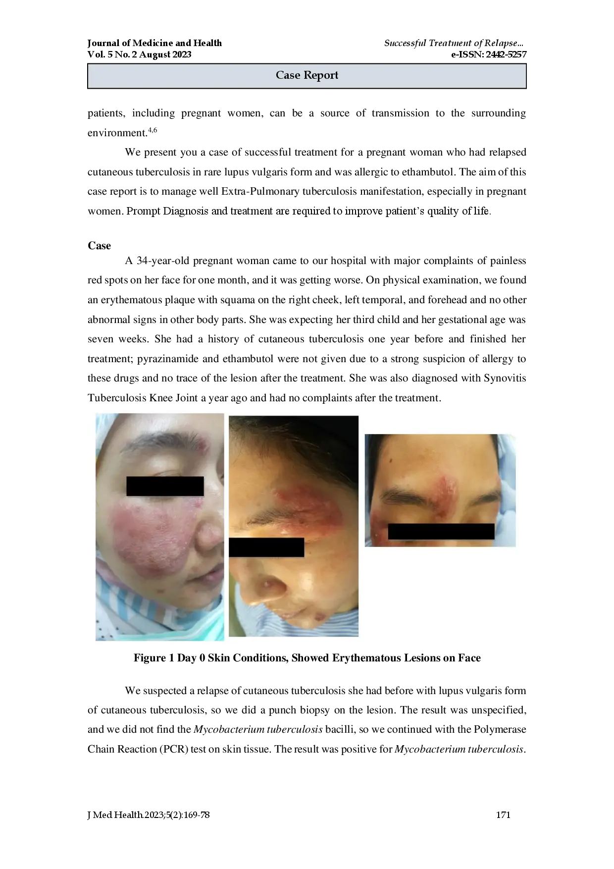 juris Successful Treatment of Relapse Cutaneous Tuberculosis on Pregnant Woman with Ethambutol Allergic