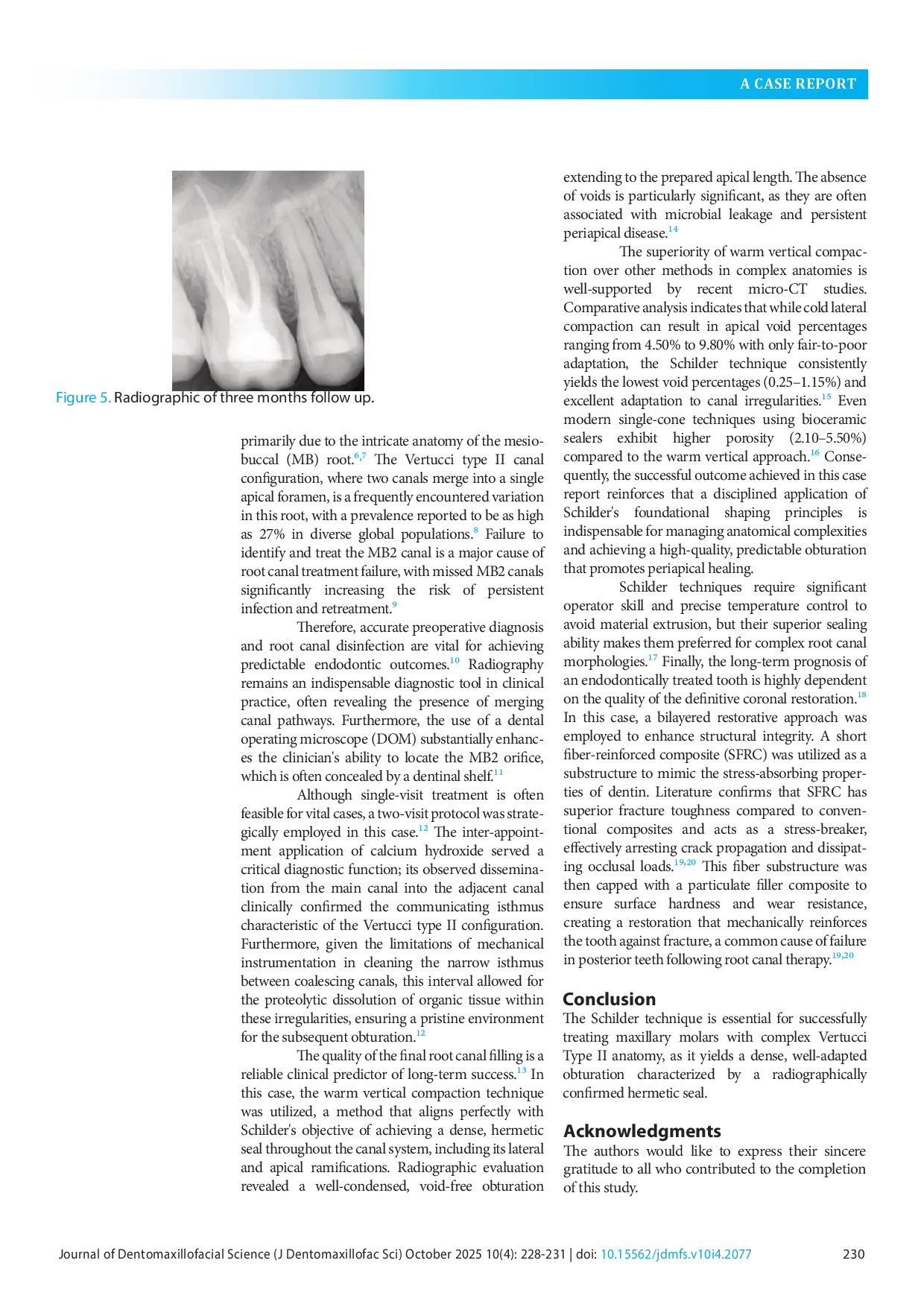 JURIS Schilder technique for vertucci type II configuration in maxillary first molar A case report