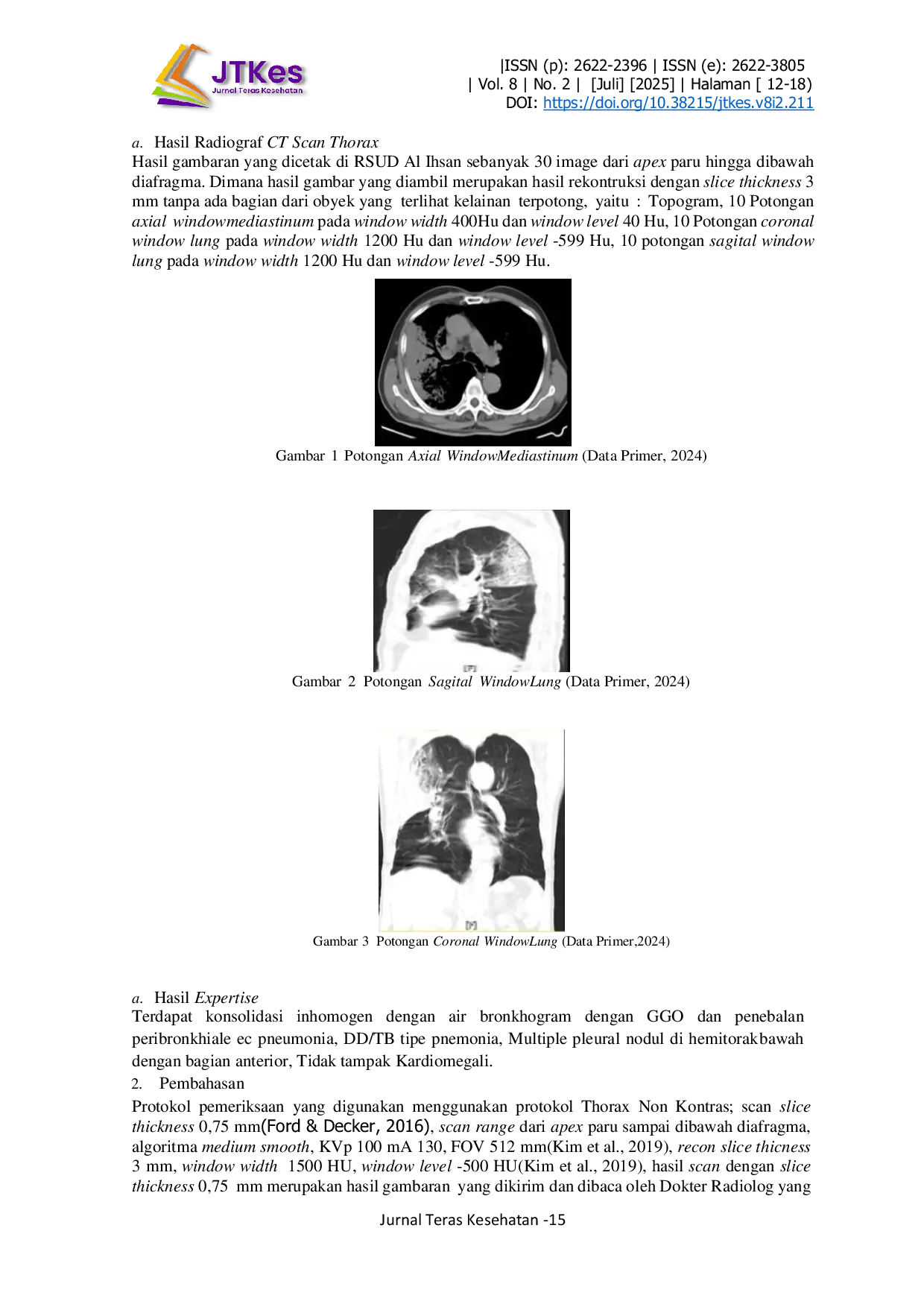 JURIS Evaluasi Pemeriksaan CT Scan Thorax Tanpa Kontras Dengan Klinis Tuberkulosis Paru Di Instalasi Radiologi Rumah Sakit Umum Daerah Al Ihsan Pemprov Jabar
