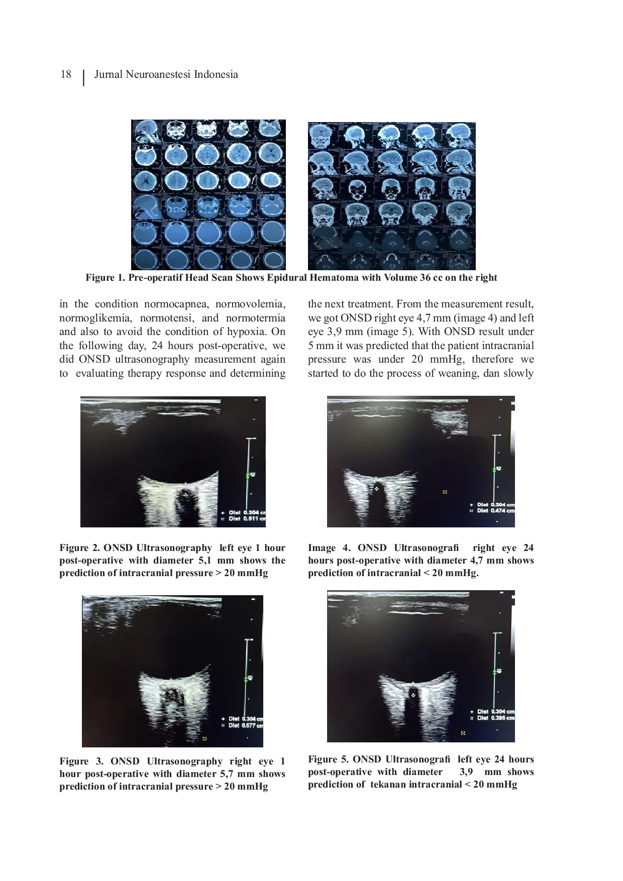 JURIS Optical Nerve Sheath Diameter ONSD Ultrasonography as Intracranial Non Invasive Pressure Measurement in Post Operative Patient EDH Evacuation in ICU