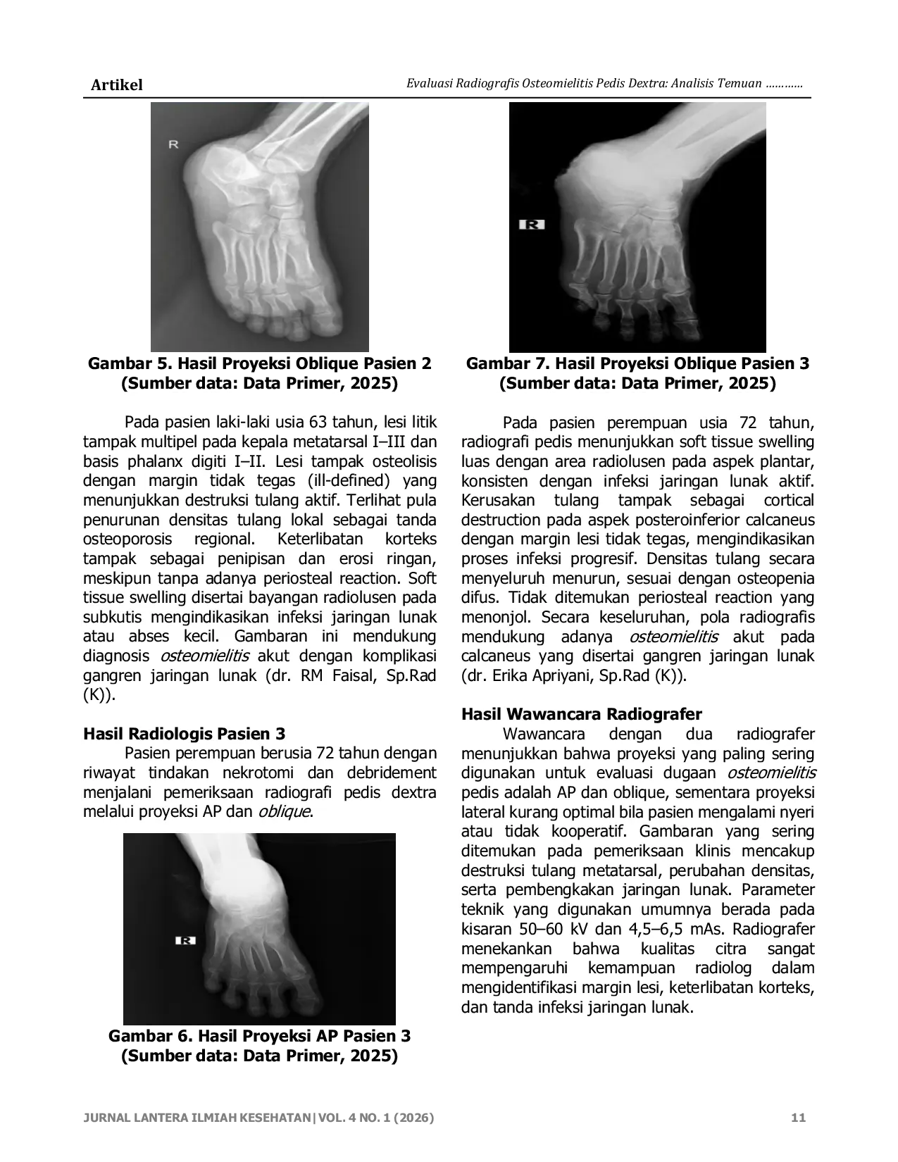JURIS Evaluasi Radiografis Osteomielitis Pedis Dextra Analisis Temuan Foto Polos di Rumah Sakit Siloam Sriwijaya Palembang