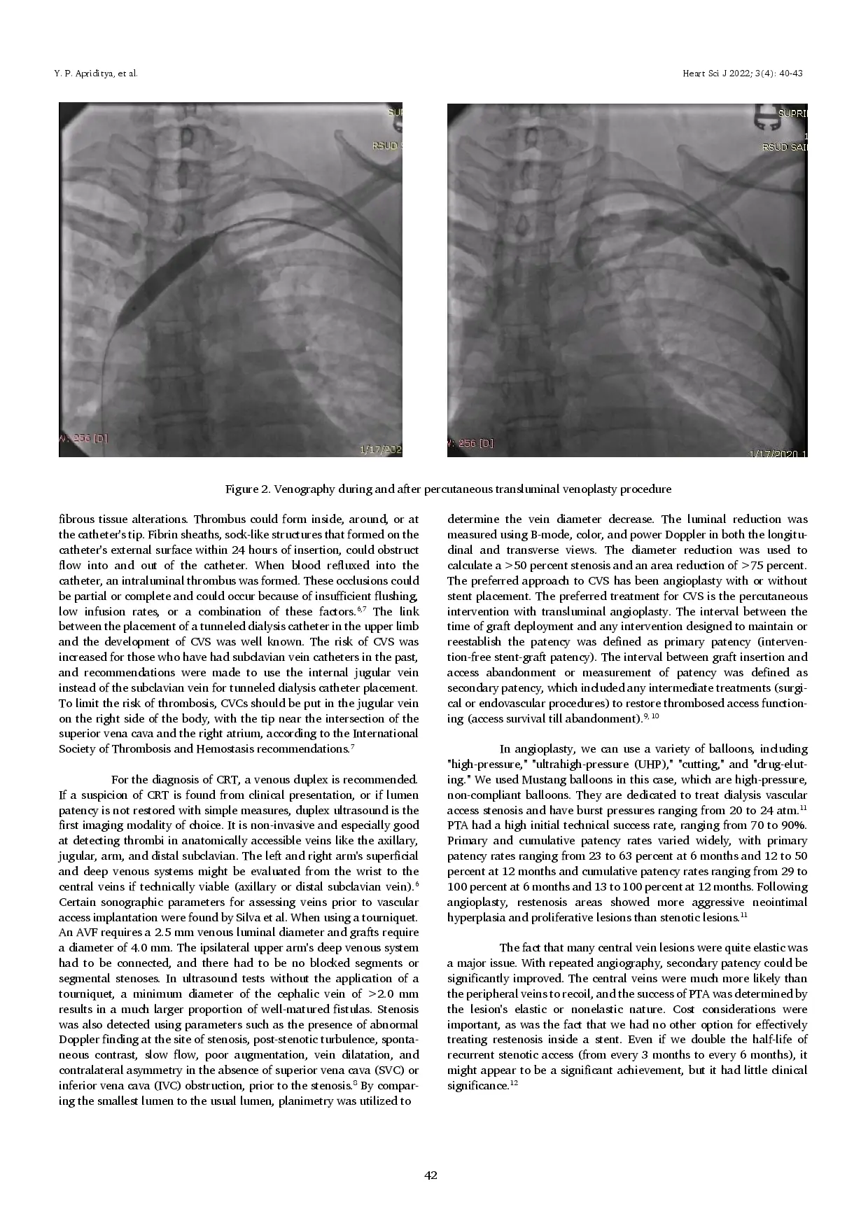 juris Central Vein Stenosis in Patient with Routine Haemodialysis From Diagnosis and Prompt Treatment A Case Report