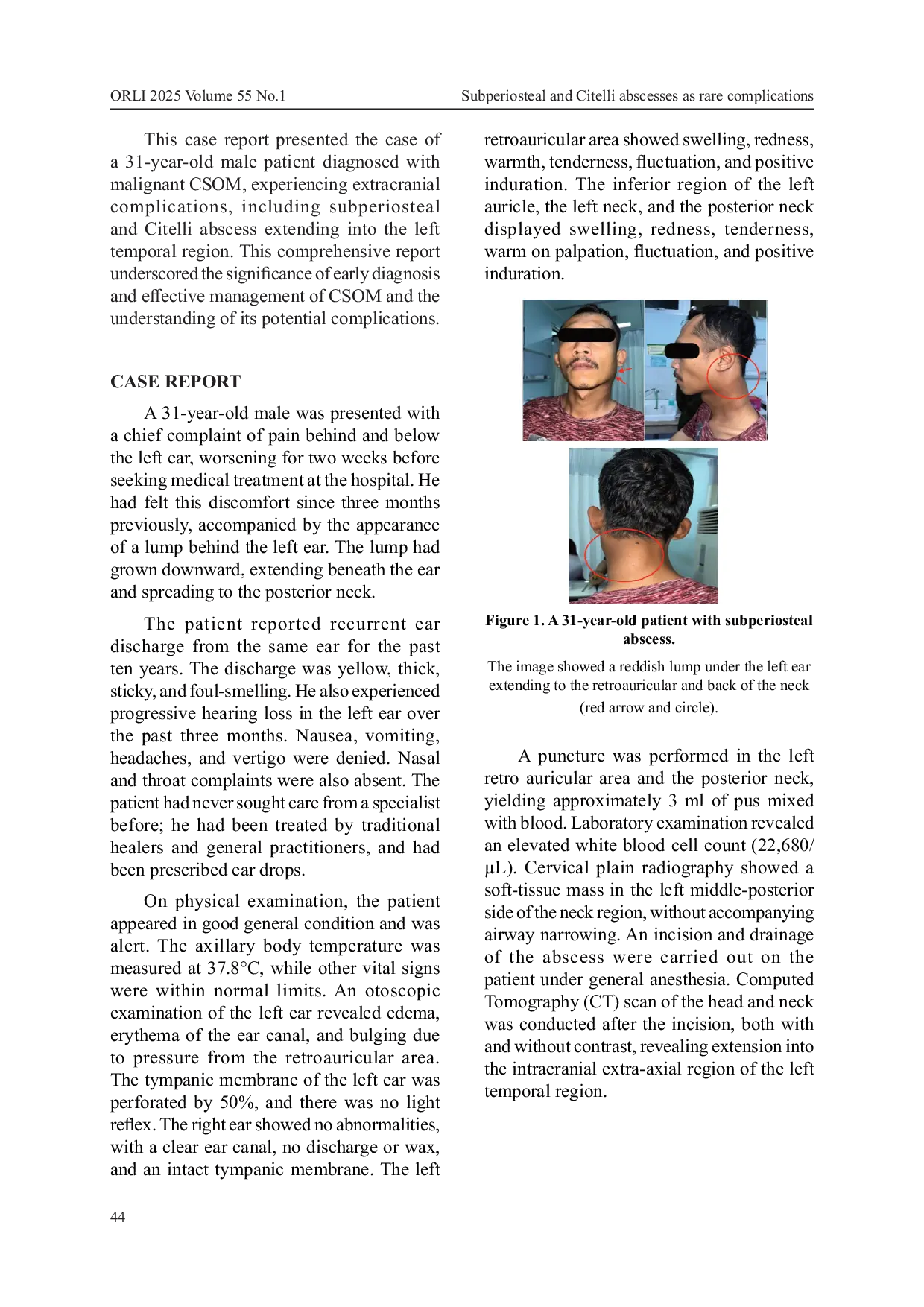 JURIS Subperiosteal and Citelli abscesses as rare complications of chronic suppurative otitis media